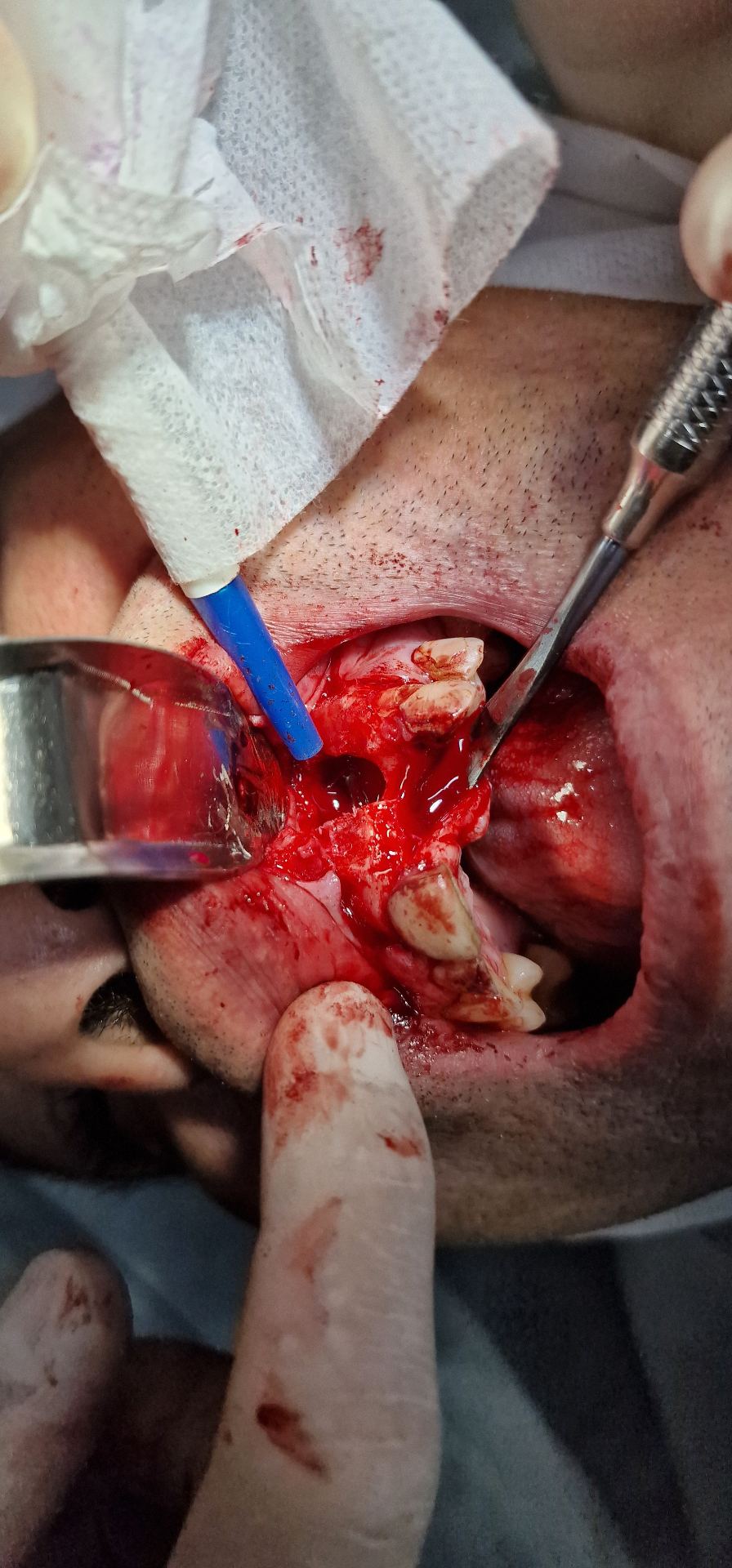 Close-up cirúrgico intra-oral com afastador e instrumentação