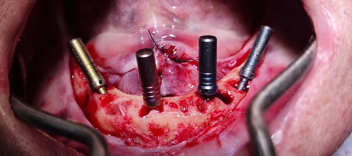 Colocação de quatro implantes para reabilitação All-on-4 na mandíbula
