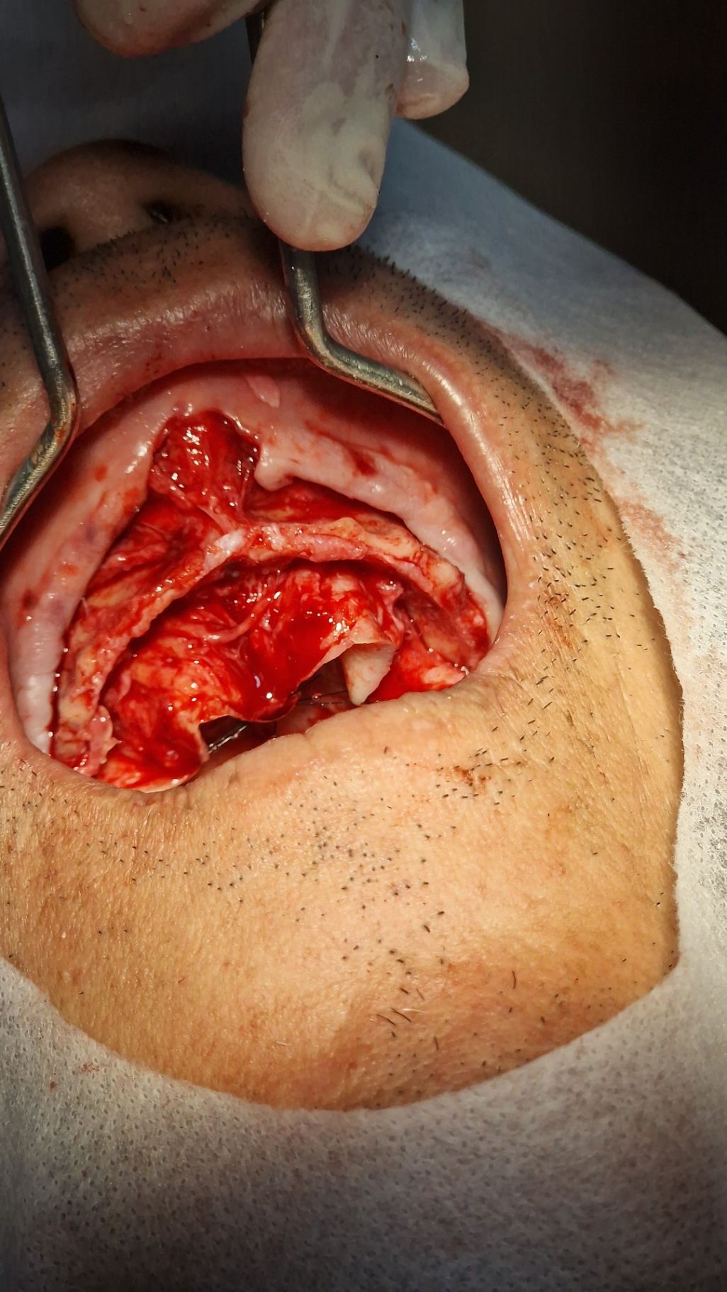 Detalhe intra-oral durante cirurgia de implantologia avançada