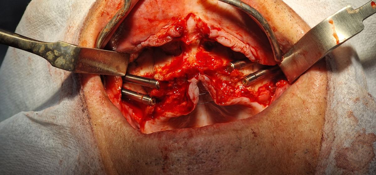 Close-up cirúrgico de colocação de implantes zigomáticos