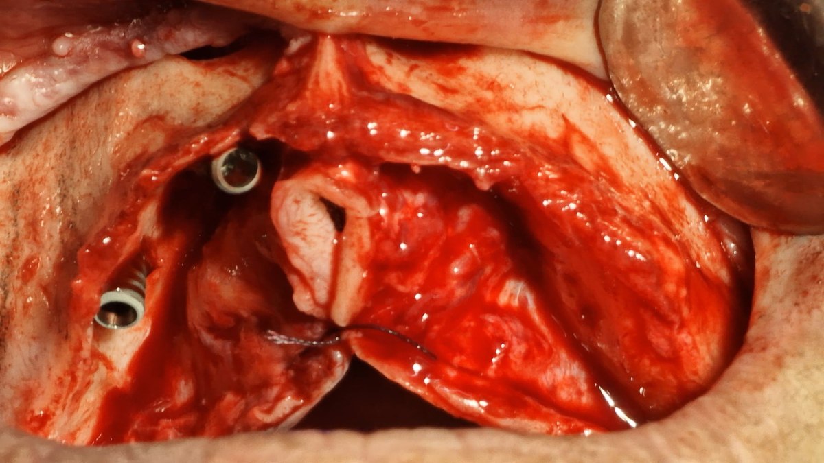 Campo cirúrgico intra-oral com retalho aberto e implantes posicionados