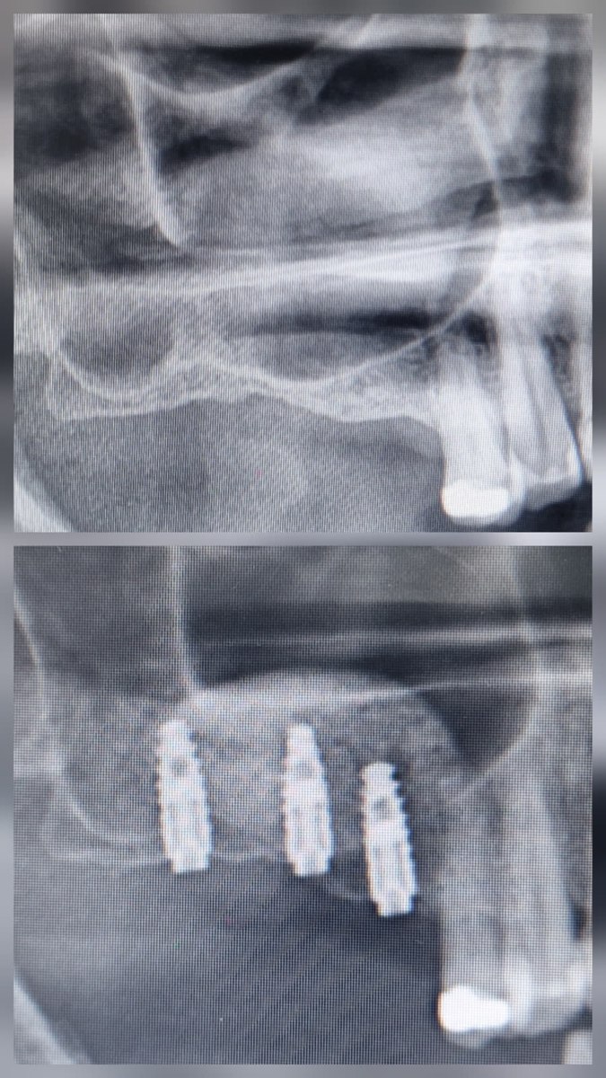 Radiografias antes e depois: defeito ósseo e implantes em posição