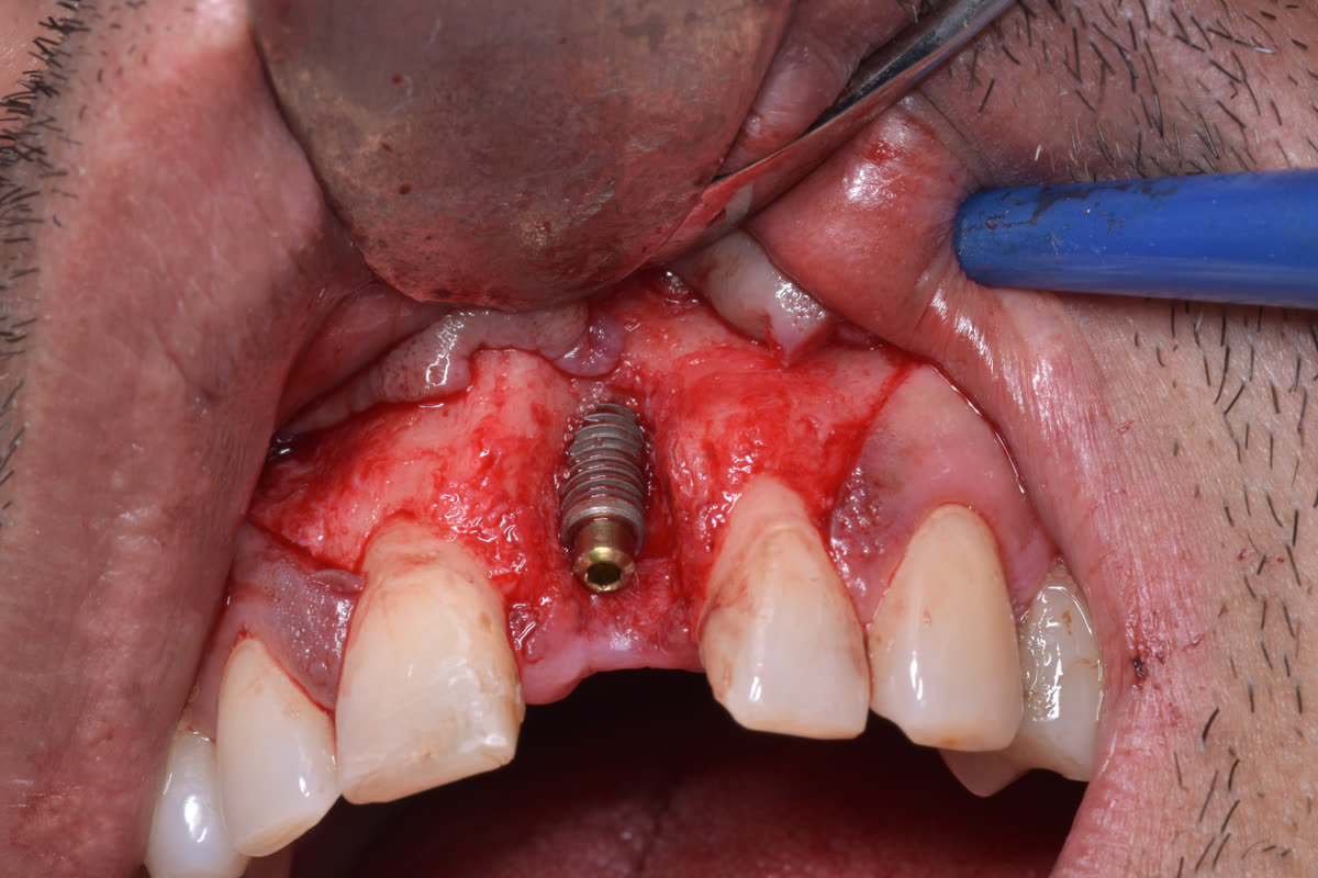 Anterior single implant with buccal bone defect before regeneration
