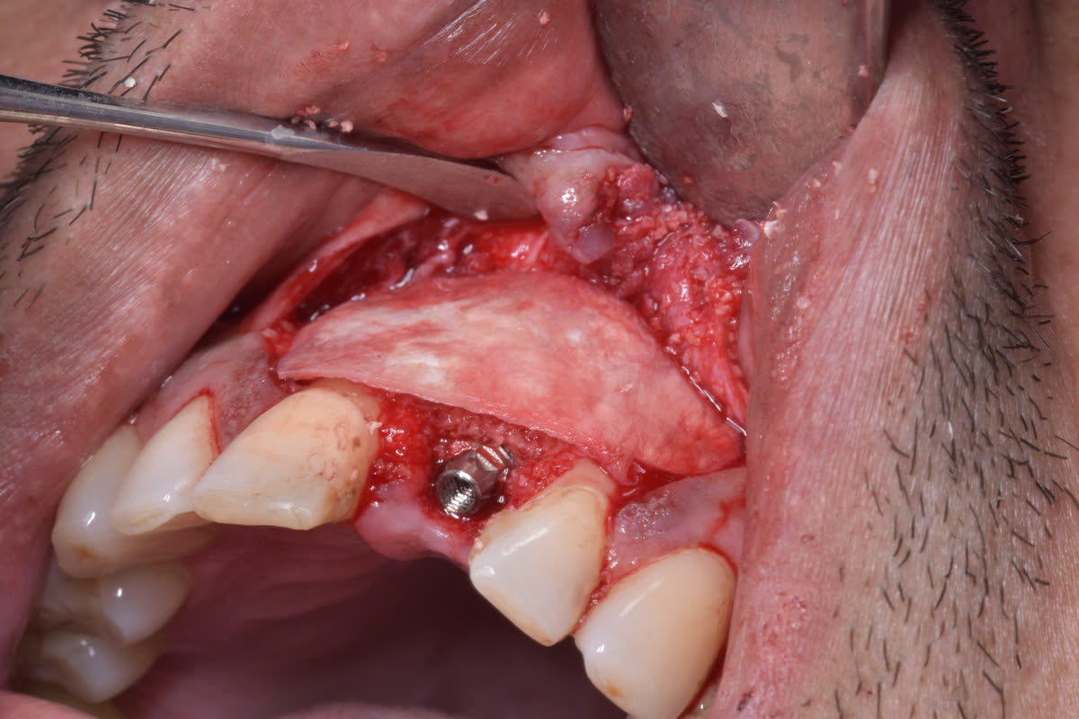 Particulate graft and membrane positioned over the implant