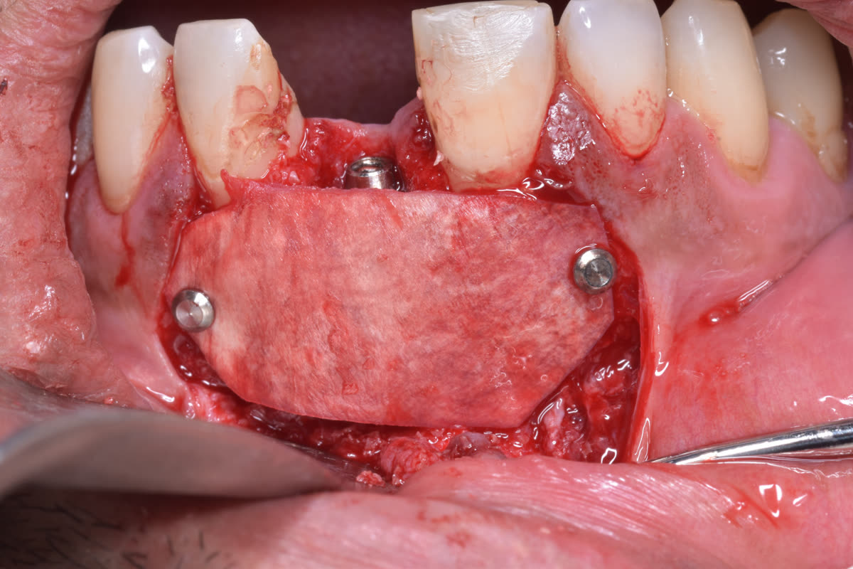 Membrane fixed with titanium pins for graft stability