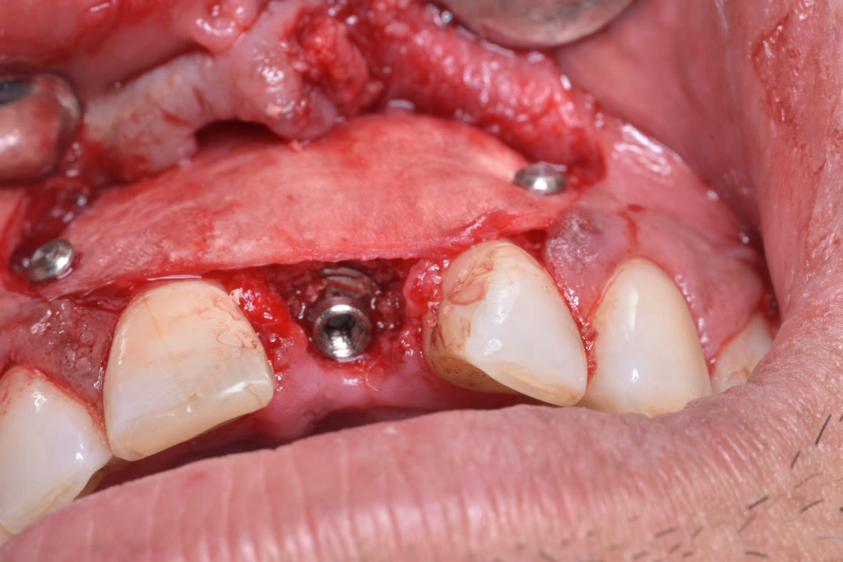 Lateral view of the membrane fixed over the regenerated defect