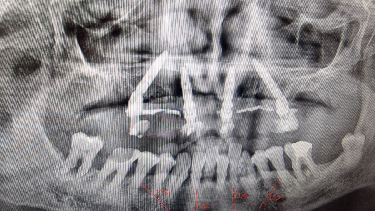 Radiografia panorâmica de reabilitação total fixa sobre implantes
