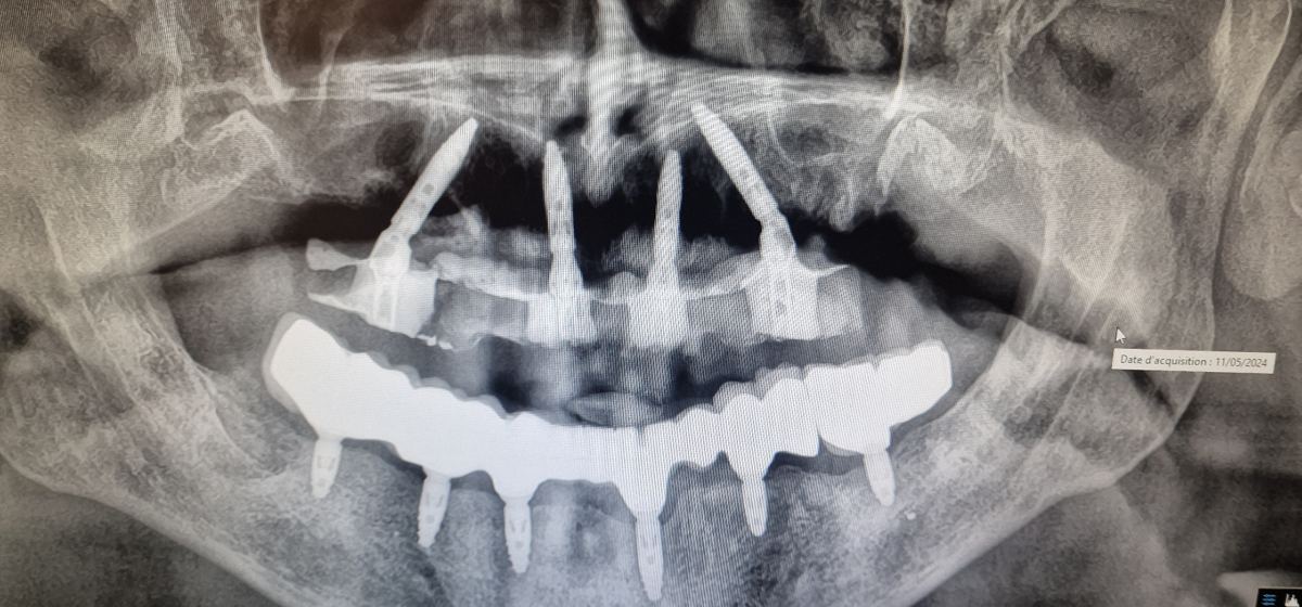 Radiografia panorâmica com implantes posteriores inclinados