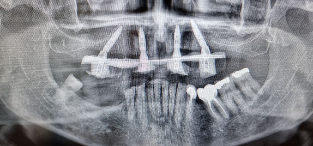 Radiografia panorâmica com maxila posterior reabilitada após elevação do seio